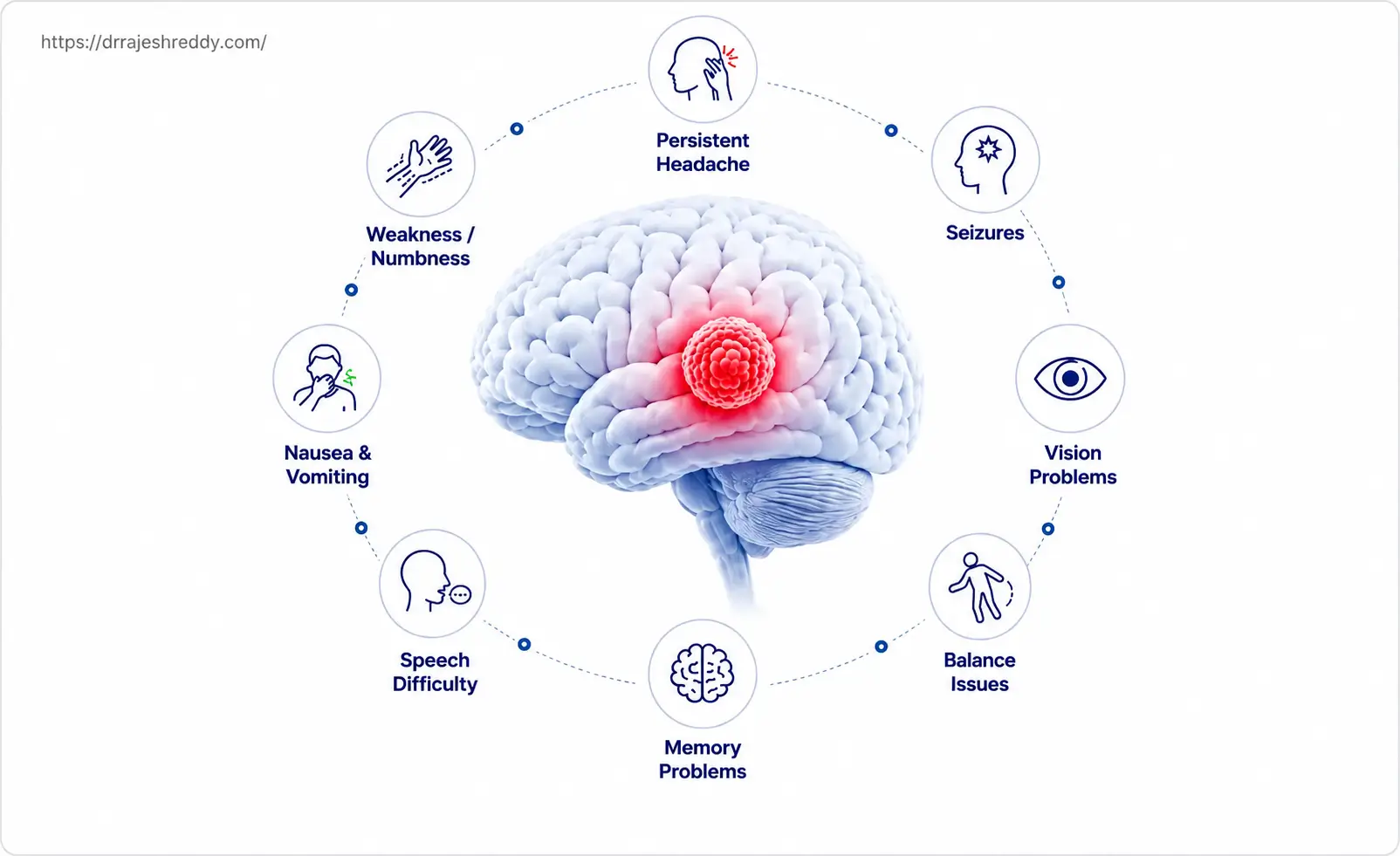 Common Brain Tumor Symptoms Overview